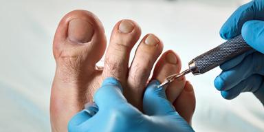 Ingrown Toenails