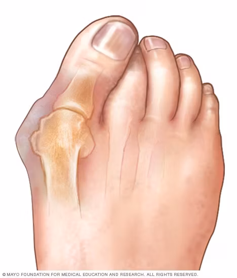 Hallux valgus