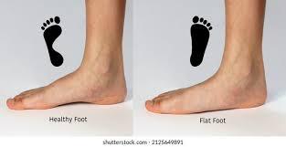 flat feet 