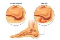 Heel Spur / Plantar Fascia