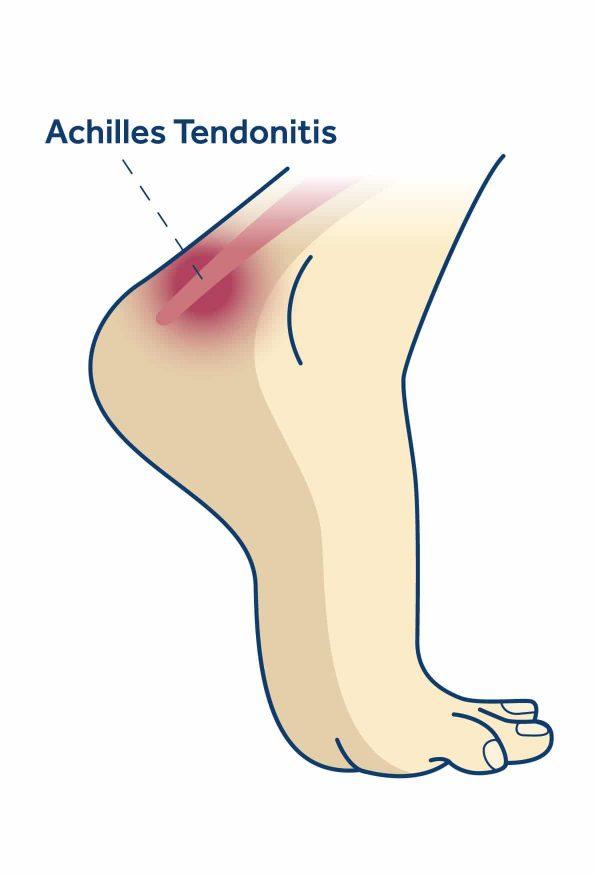Achillies tendonitis