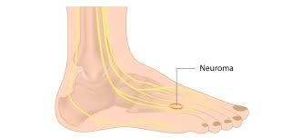 Neuroma